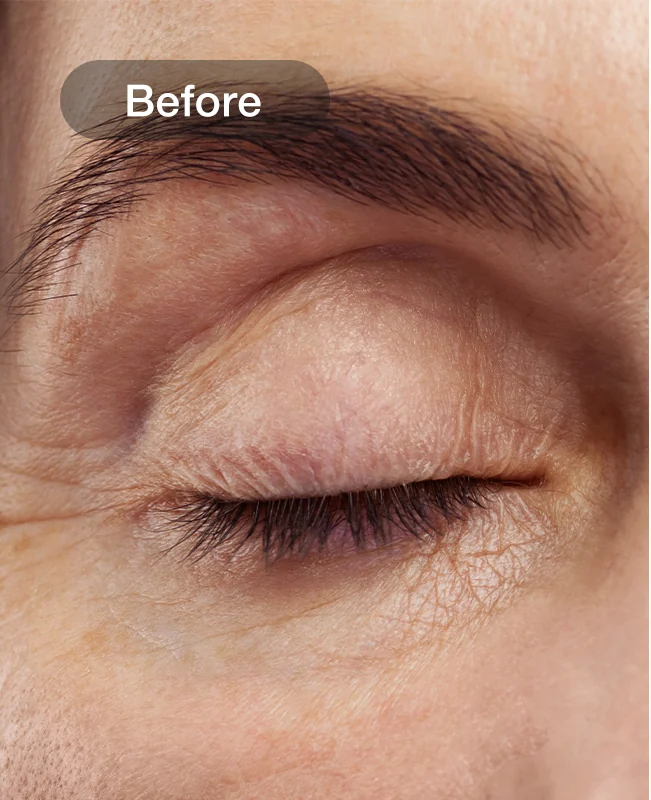 Wrinkle Reduction