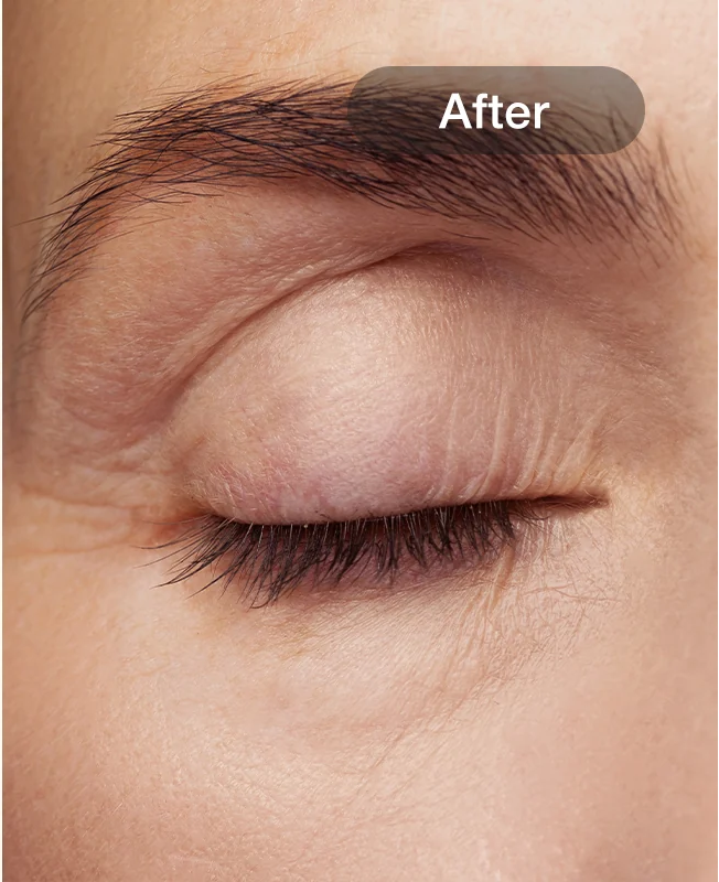 Wrinkle Reduction